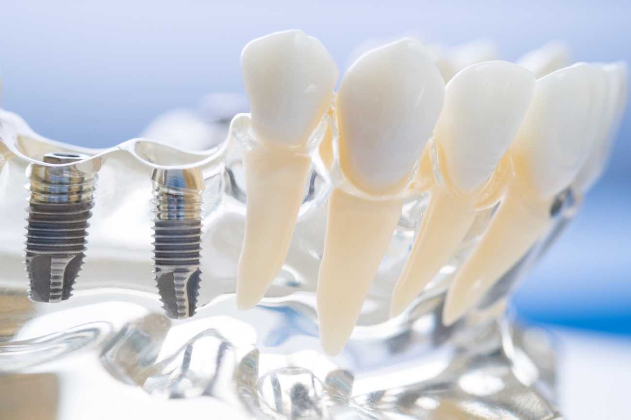 implantes diente